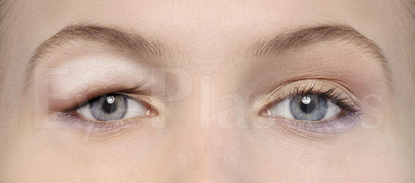 Cosmetic eyelid surgery, Blepharoplasty, Eyelift